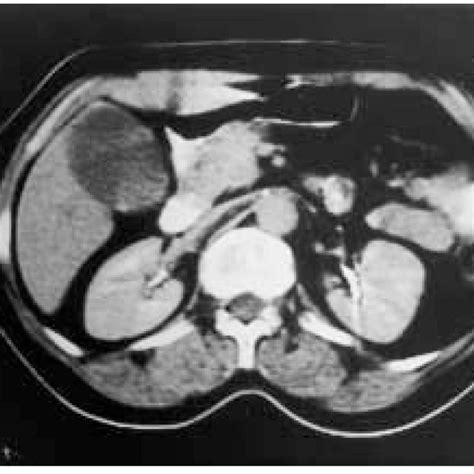 CT Scan Of The Abdomen Showing A Solid Mass In The Head Of The Pancreas