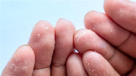 Std Skin Peeling On Hands Atelier Yuwaciaojp