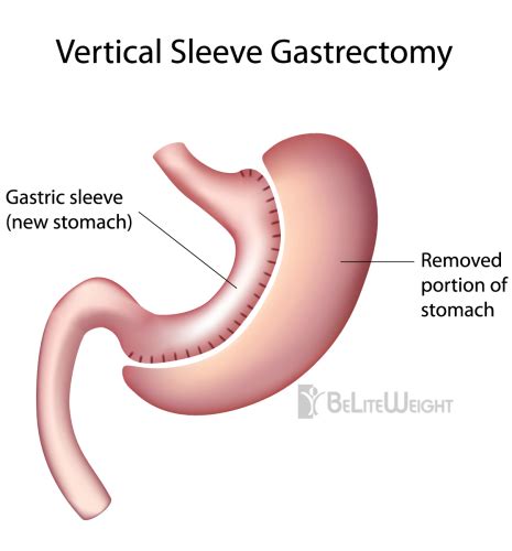 Gastric Sleeve Vertical Sleeve Gastrectomy Beliteweight Weight Loss Services