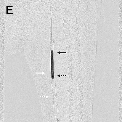 Trinias Minimally Invasive Experience