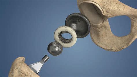 Revision Hip Replacement Understandortho