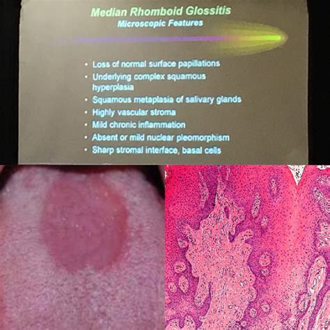 Median Rhomboid Glossitis Histology