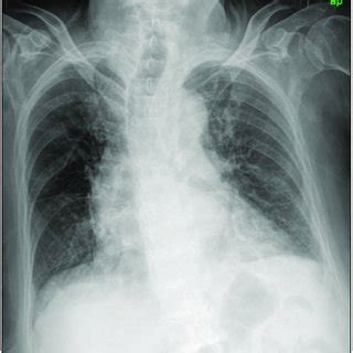 Supine Anteroposterior Chest Radiograph Showing Suspicious Infiltrates