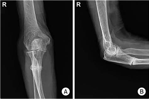 Initial Anteroposterior A And Lateral B Radiographs Show A