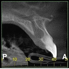 Cisto Do Canal Nasopalatino NelmaRadiologia