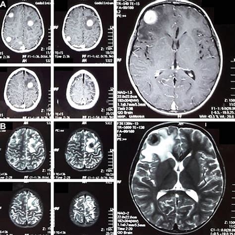 AC Axial Sagital T1 Weighted With Contrast And Axial T2 Weighted MR