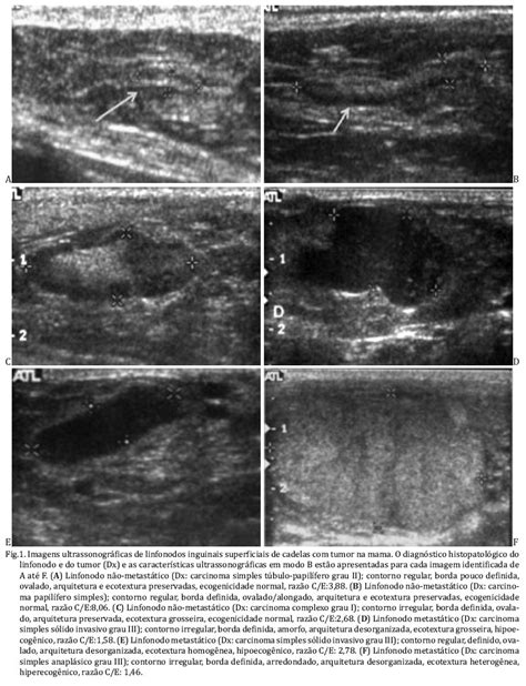 Scielo Brasil Avalia O Ultrassonogr Fica De Linfonodos Na Pesquisa