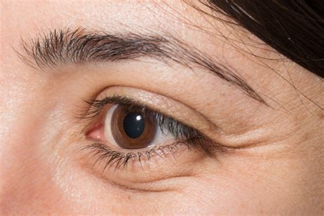 Causes Of Swollen Puffy Under Eyes