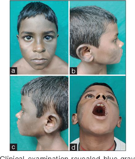 Figure 1 From Bilateral Nevus Of Ota A Case Series And Literature