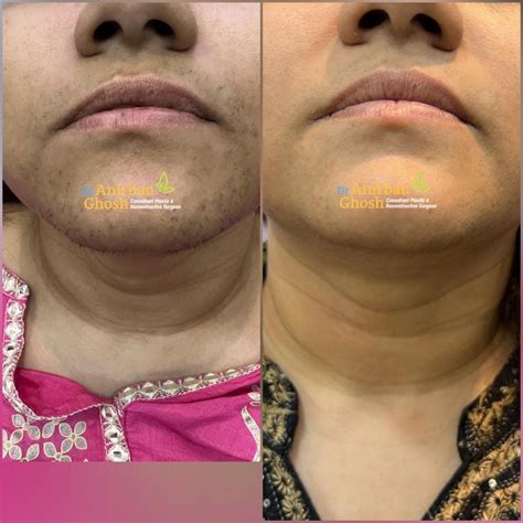 Before After Dr Anirban Ghosh Top Plastic Surgeon In Kolkata