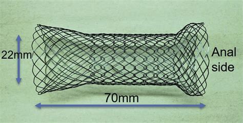 The Newly Developed Proximal Release Type Colonic Stent Download