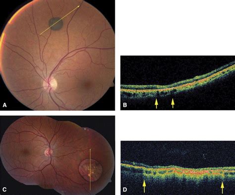 Photoreceptor Loss Overlying Congenital Hypertrophy Of The Retinal