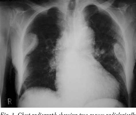 Figure From Brown Tumor A Rare Manifestation Of Renal Osteodystrophy