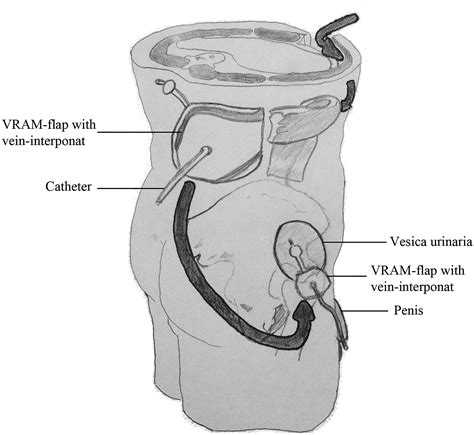 Plastic Reconstructive Surgery Techniques Using VRAM Or Gracilis Flaps