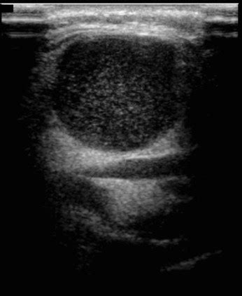 A Study To Evaluate The Accuracy Of Ultrasound In The Diagnosis Of