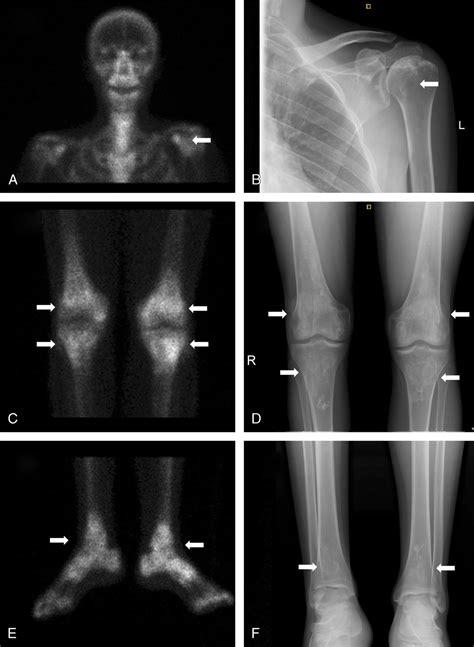 Multifocal Osteonecrosis The Usefulness Of Bone Scintigraph Jcr