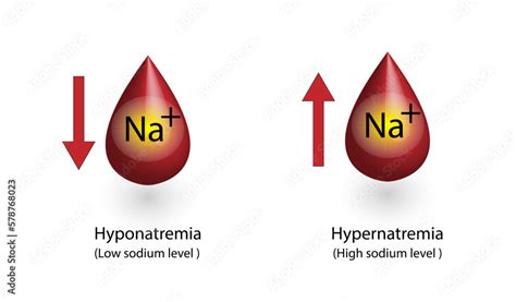 Hypernatremia High Plasma Sodium Level And Hyponatremia Low Plasma