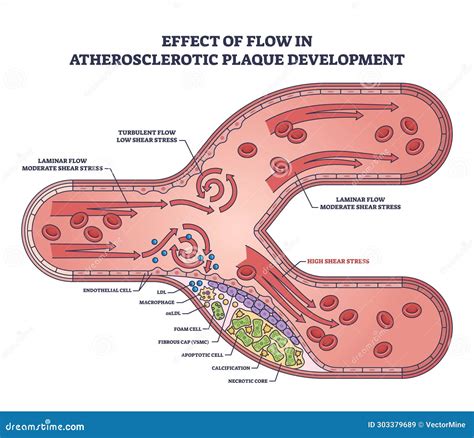 Effect Of Flow In Atherosclerotic Plaque Development Outline Diagram