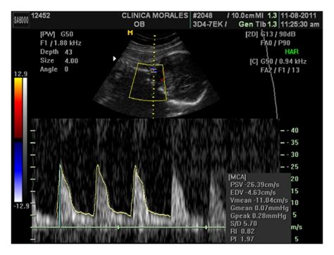 Week 28. Transvaginal colour Doppler ultrasound. The aberrant cotyledon ...