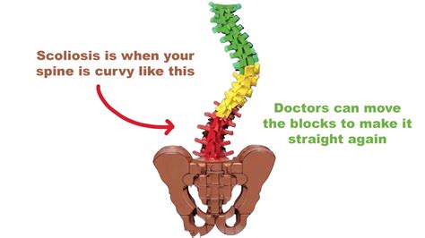 Adolescent Idiopathic Scoliosis Qusai Hammouri Md