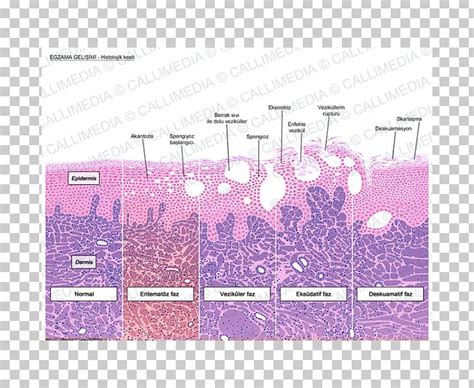 Histology Keratinocyte Dermatitis Corte Histol Gico Acanthosis Png