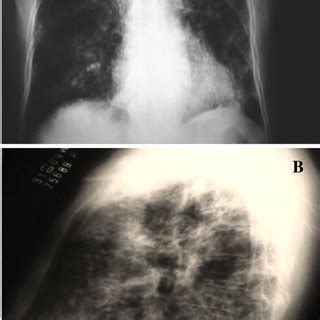 Radiography Of The Thorax Anteroposterior View A And Lateral View