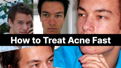 How To Treat Acne Fast Proven Tips For Clear Skin Quickly 🧼 Youtube