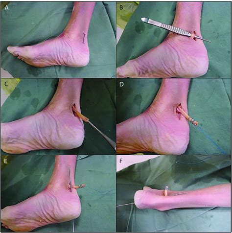 A Posteromedial Incision Created B Identification Of The Flexor