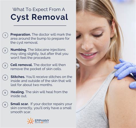 How To Prevent Sebaceous Cysts - Sonmixture11