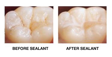 The Benefit Of Sealants Heights Pediatric Dentistry Orthodontics