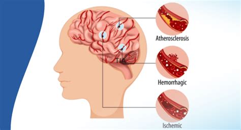 What Are the Symptoms of Brain Stroke