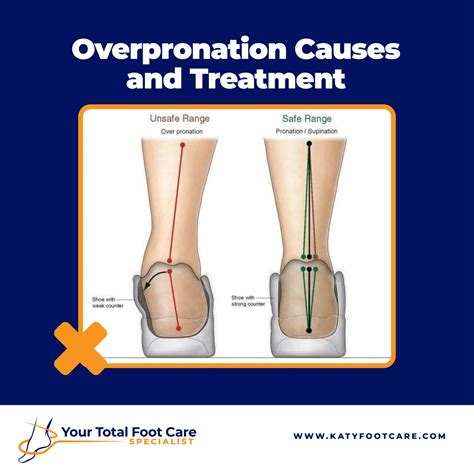 What Causes Pronation Of Foot High Arch Feet (Pes Cavus): Causes,