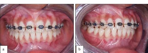 Figure From Management Of Maxillary Midline Diastema Caused By