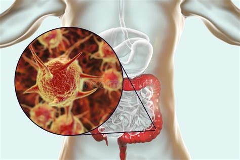 Parasitic Infection of Intestine Stock Illustration - Illustration of ...