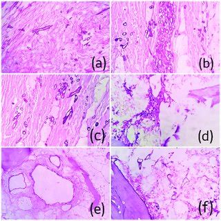 A D F Photomicrographs Of H E Stained Sections Of Case Number E