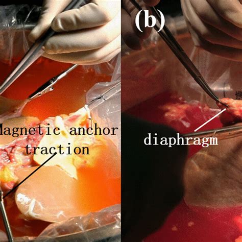 Supra Hepatic Inferior Vena Cava Trimming A Mat Group B Manual Group