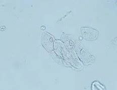 Leukocytes in Urine - No Nitrates, Normal Range, Treatment