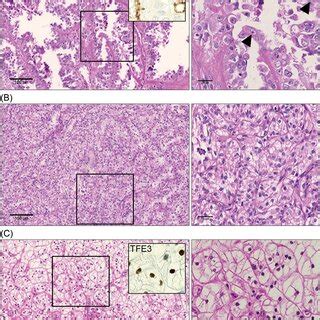 Histology of representative cases of molecularly defined RCC subtypes ...