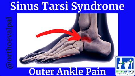 Sinus Tarsi Syndrome Outer Ankle Pain Youtube