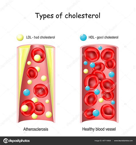 Good Bad Cholesterol Comparison Hdl Ldl Lipoprotein Healthy Narrowed