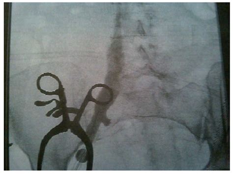 Venogram Depicting Complete Ivc Thrombosis Download Scientific Diagram