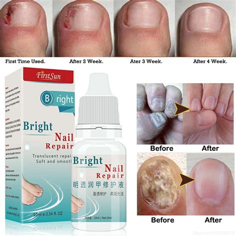 Ml Nail Fungus Treatment Cream Onychomycosis Paronychia Anti Fungal