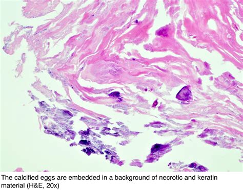 Pathology Outlines Schistosomiasis Bilharziasis