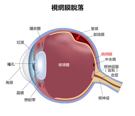 視網膜脫落 香港激光矯視中心