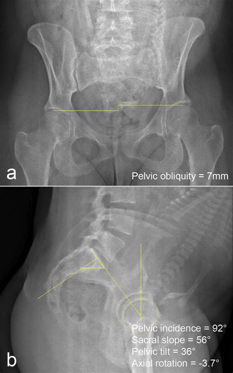 Evaluation Of Pelvic Incidence Sacral Slope Pelvic Tilt Axial