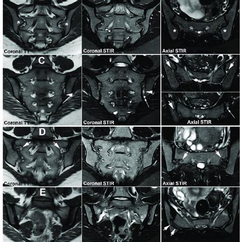 Anatomical SIJ variation. The figures illustrate the spectrum of SIJ ...