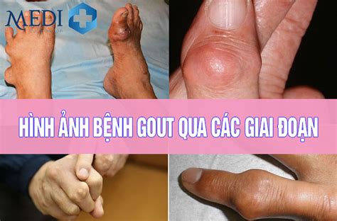 Thư viện hình ảnh hình ảnh bệnh gout diễn tả dấu hiệu và triệu chứng