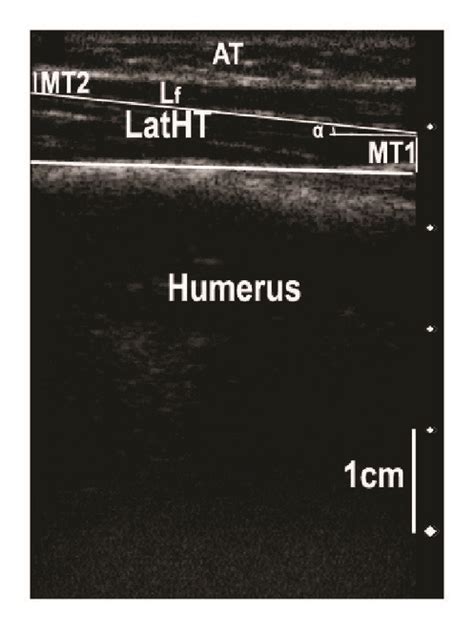 Typical Ultrasonography Imaging Of The Prime Elbow Extensors Long Head Download Scientific