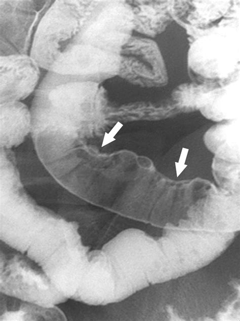 Crohn Disease Of The Small Bowel Comparison Of CT Enterography MR