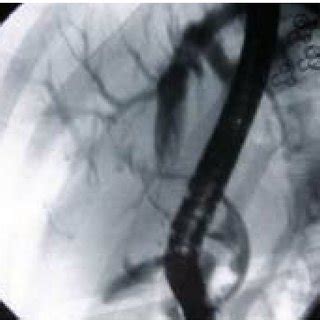 A Endoscopic Retrograde Cholangiography Shows A Smooth Oval Filling